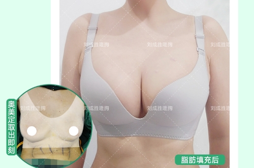 奥美定取出术后40天：胸部刺痛感是否属于康复正常现象？